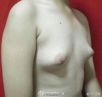 【中国】フライドチキンを食べまくって巨乳になった男